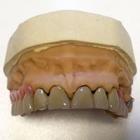 Lavoro su corone telescopiche