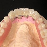 Protesi combinate su impianti