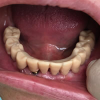 Prova di struttura in resina provvisoria, nel cavo orale